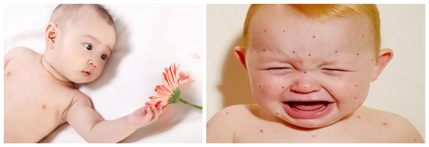 兒童濕疹反反復復，您有在家安裝家用除濕產品嗎？